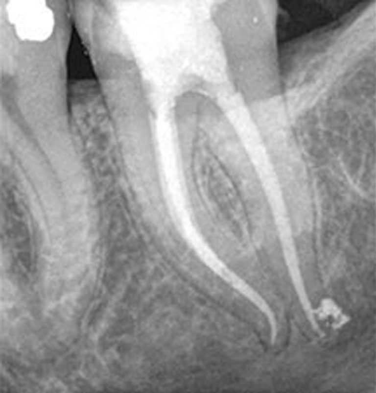 6 WaveOne Gold Wave One Files 25mm Primary Endodontic Root Canal