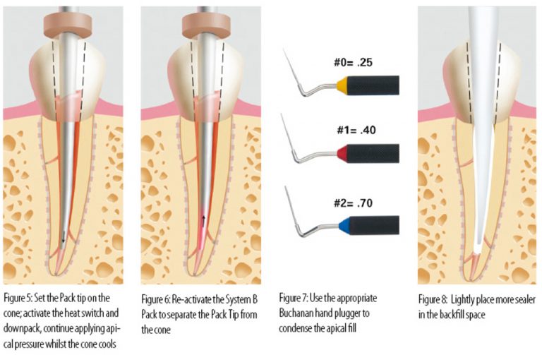 3y WARRANTY Sybron Endo New Touch'n Heat 5004, W 1 Buchanan Tip, ALL U