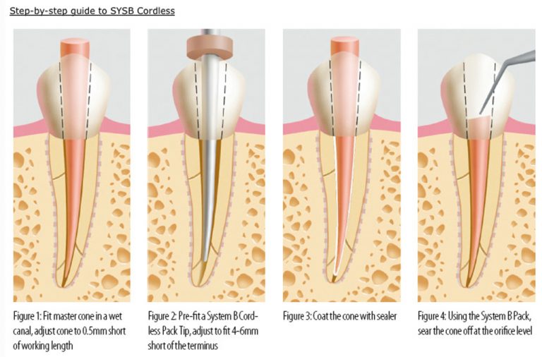 TUTTI I PLUGGER Di Calore Odontoiatrici Kerr SybronEndo - Foto 6