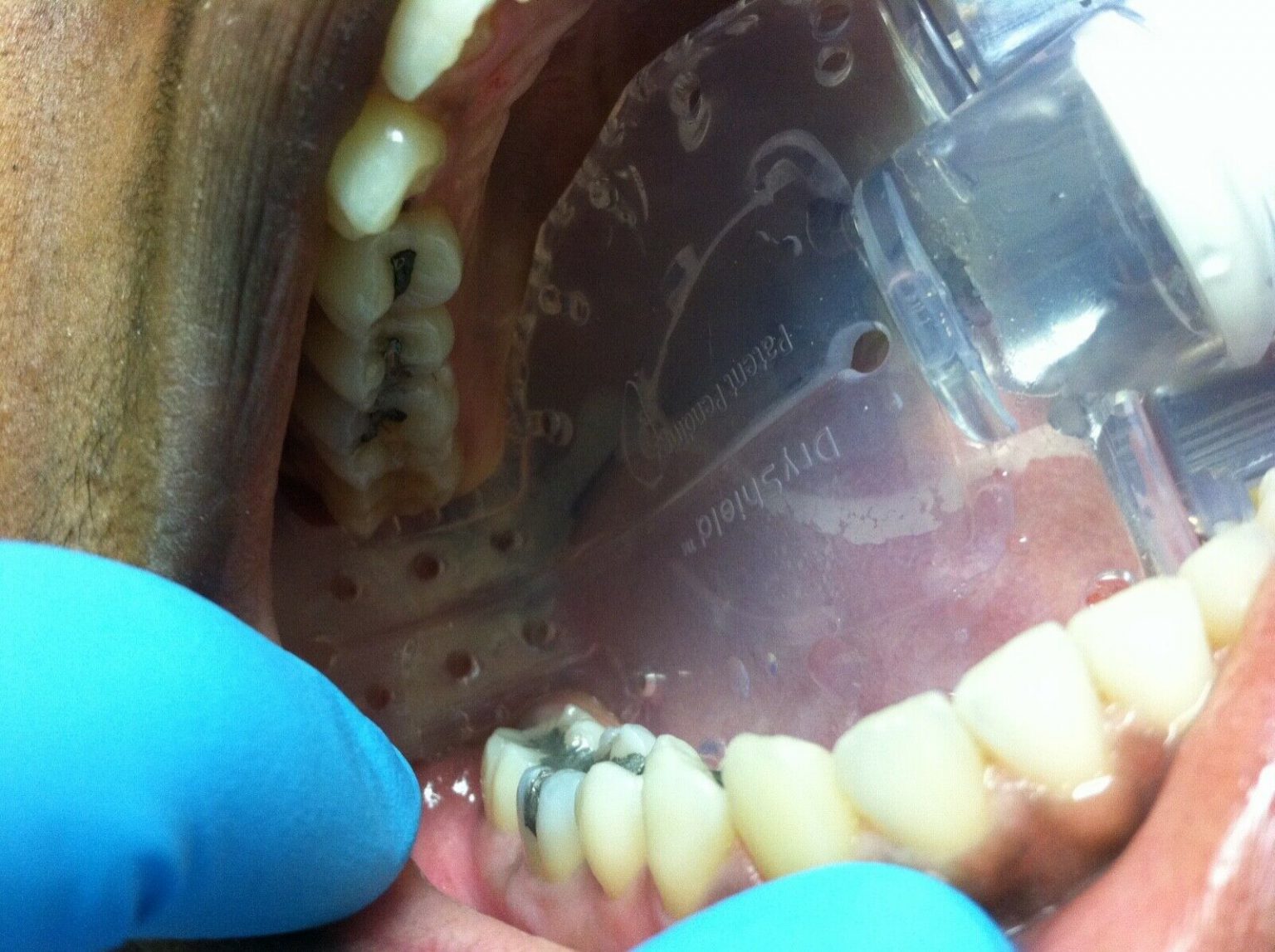 DRYSHIELD DENTAL ISOLATION MOUTH PIECES AUTOCLAVABLE 2 LARGE READ