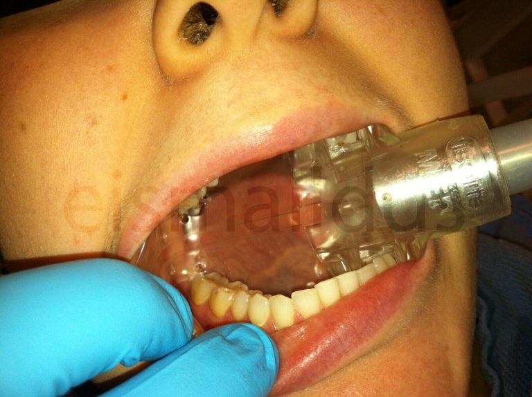 Dryshield Dental Isolation Dryshield Dental Mouth Piece 2 Pieces Medium